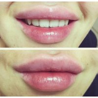 Увеличение губ: мой опыт