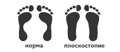 Плоскостопие