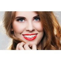 Разновидности брекет-систем